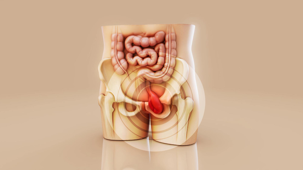 Cirugía de hernia inguinal con malla